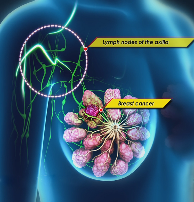 Sentinel Lymph Node Biopsy