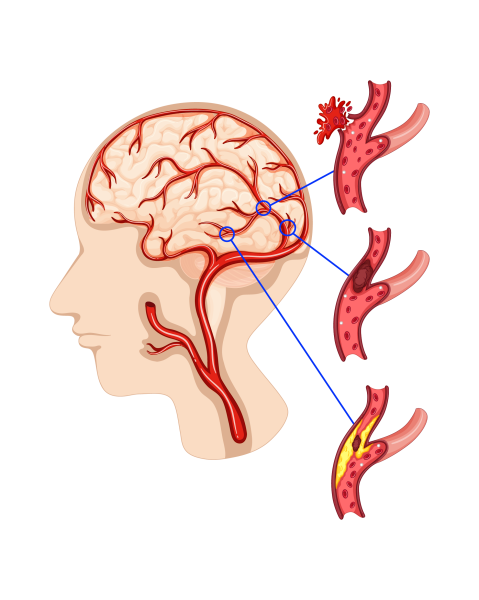 Causes and Risk Factors of Head and neck Cancer-01